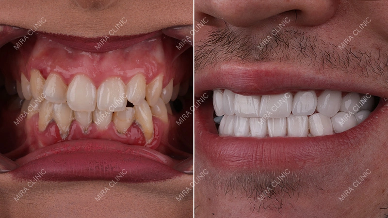 Before and After: Real Front Teeth Smile Makeover Result